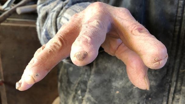 10 barmağını itirdi, sevdiyi peşəni atmadı - Onu görən hər kəs şoka düşür - FOTO