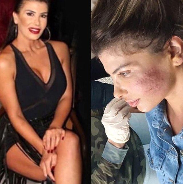 Müğənninin üzü yandı - FOTO