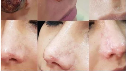 Azərbaycanda kosmetoloq qızın burnunu çürütdü - FOTO