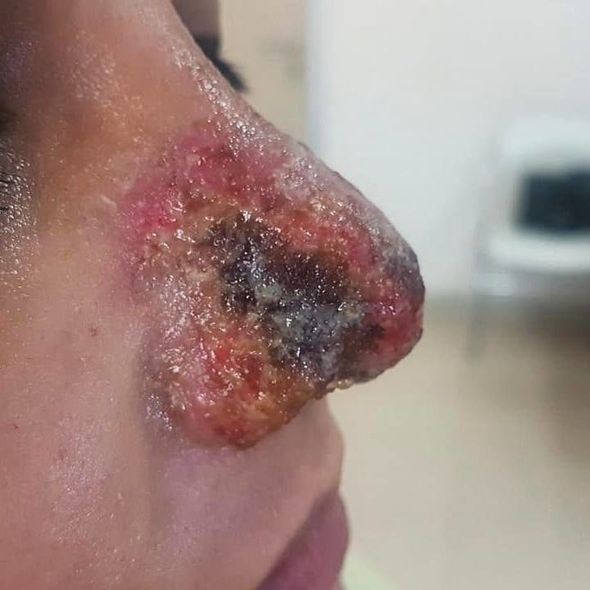Azərbaycanda kosmetoloq qızın burnunu çürütdü - FOTO