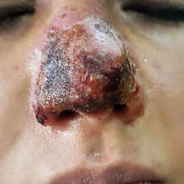 Azərbaycanda kosmetoloq qızın burnunu çürütdü - FOTO