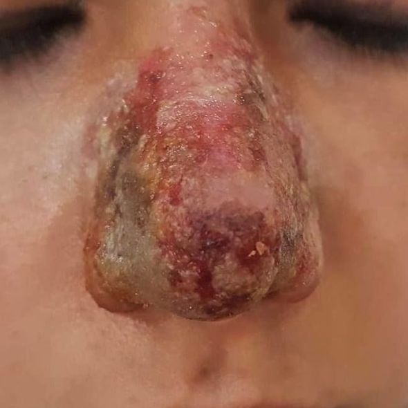 Azərbaycanda kosmetoloq qızın burnunu çürütdü - FOTO