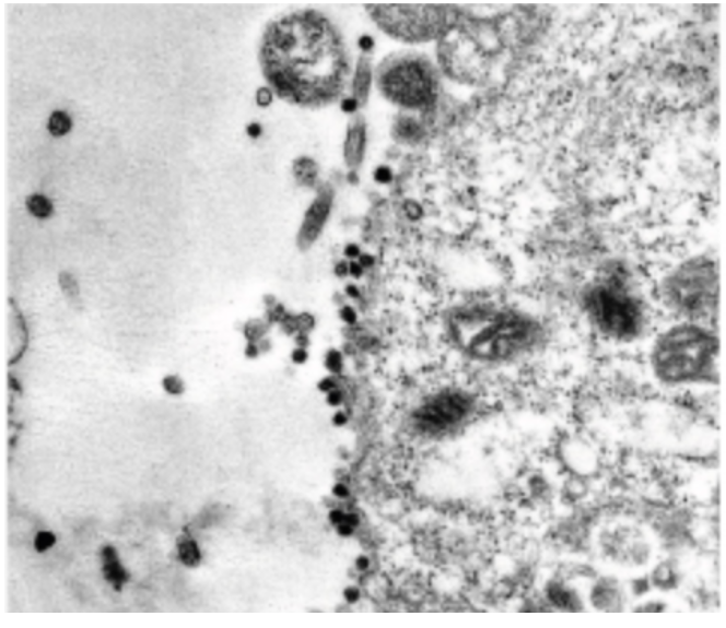 Koronavirus sağlam hüceyrələrə belə hücum edir - FOTOLAR