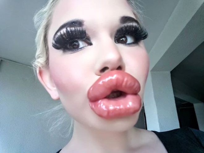 Ən böyük dodağa sahib olmaq üçün 20-dən çox əməliyyat keçirdi