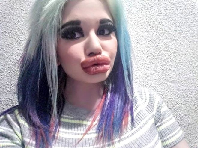 Ən böyük dodağa sahib olmaq üçün 20-dən çox əməliyyat keçirdi