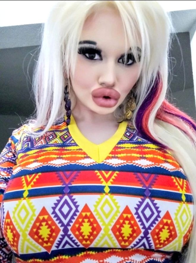 Ən böyük dodağa sahib olmaq üçün 20-dən çox əməliyyat keçirdi