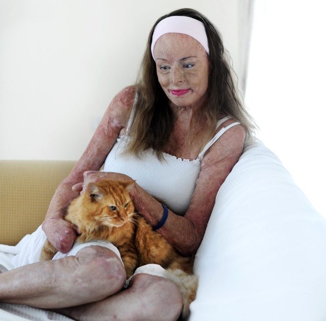 Bədəninin 85 faizini itirən "gözəllik kraliçası" poza verdi  -  FOTO