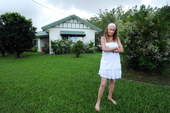 Bədəninin 85 faizini itirən "gözəllik kraliçası" poza verdi  -  FOTO