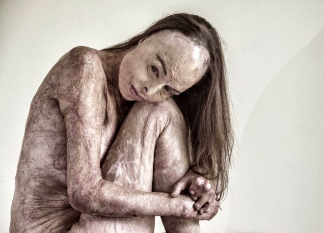 Bədəninin 85 faizini itirən "gözəllik kraliçası" poza verdi  -  FOTO