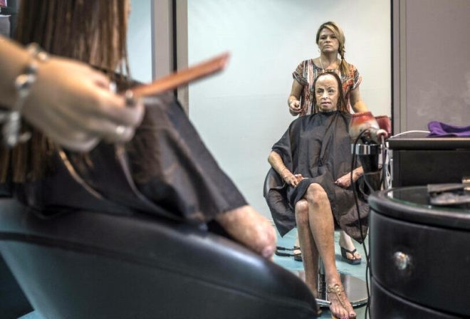 Bədəninin 85 faizini itirən "gözəllik kraliçası" poza verdi  -  FOTO