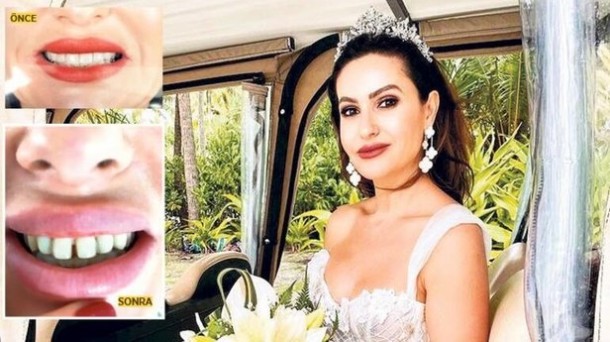 Hande Erçelə bənzəmək istəyən model dişsiz qaldı - FOTO