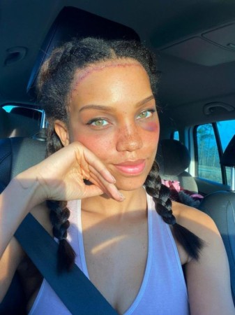 Model alnını əməliyyatla kiçiltdi - FOTOLAR