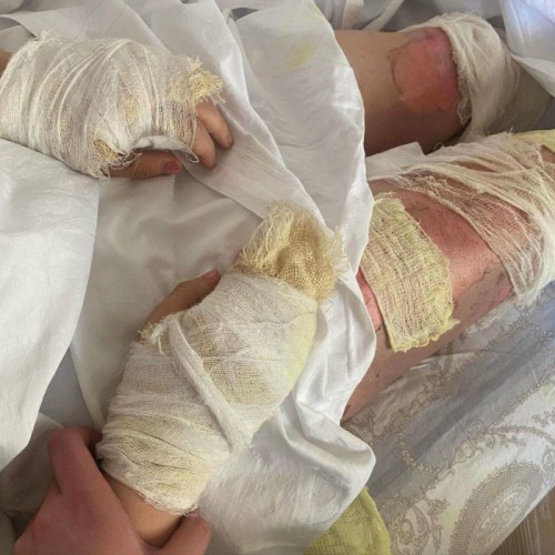 Partlayışda ağır yaralanan blogger tanınmaz halda - FOTO