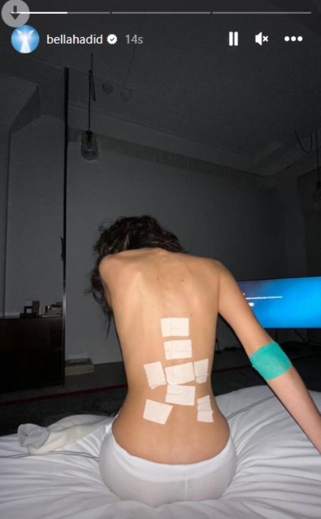 Məşhur model bu xəstəlikdən əziyyət çəkir - FOTOLAR