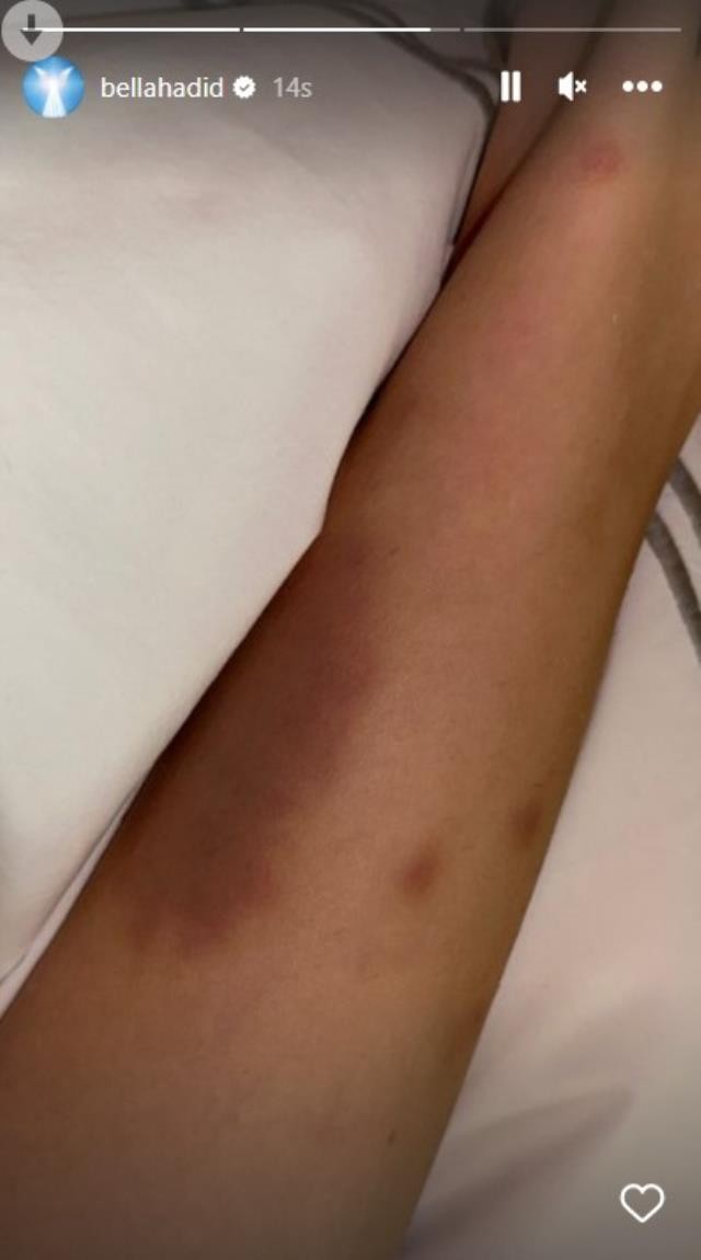 Məşhur model bu xəstəlikdən əziyyət çəkir - FOTOLAR