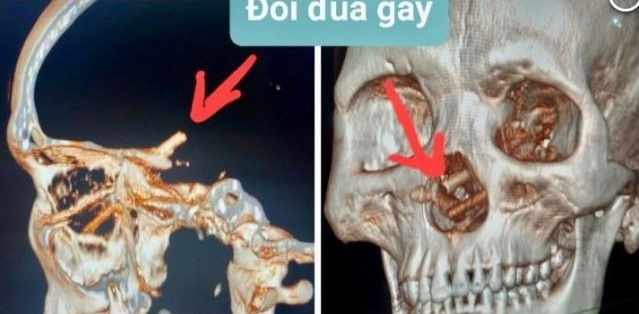 Aylardır başı ağrıyan kişinin beynindən iki çubuq çıxdı - FOTO