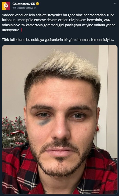 Qapı dirəyinə çırpılan İkardinin sümüyü sındı - FOTO