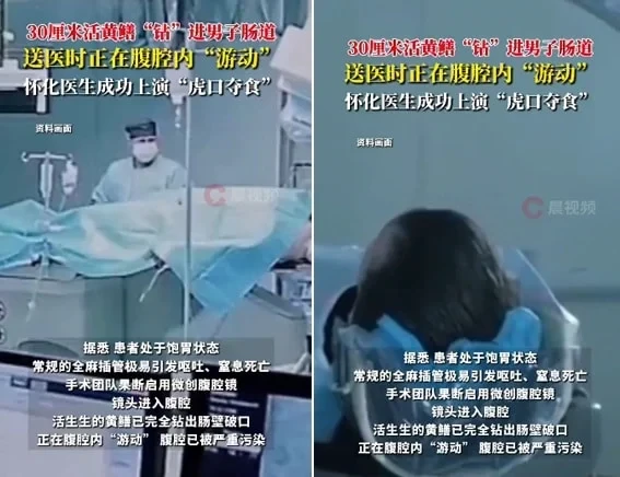 Qarın ağrısı ilə xəstəxanaya getdi - Mədəsində diri ilan balığı tapıldı