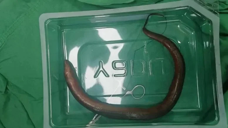 Qarın ağrısı ilə xəstəxanaya getdi - Mədəsində diri ilan balığı tapıldı