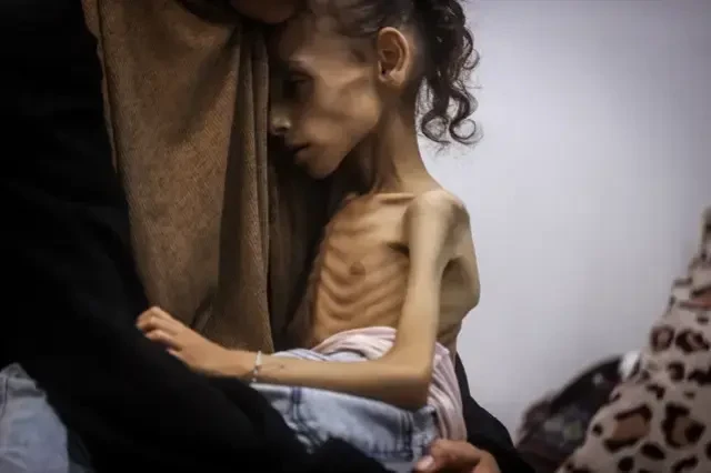 Yaşı 9, çəkisi 10 kq olan qəzzalı qızcığaz - FOTOLAR