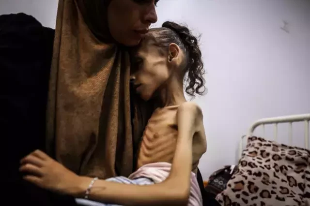 Yaşı 9, çəkisi 10 kq olan qəzzalı qızcığaz - FOTOLAR