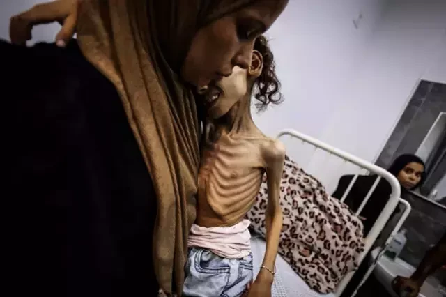 Yaşı 9, çəkisi 10 kq olan qəzzalı qızcığaz - FOTOLAR