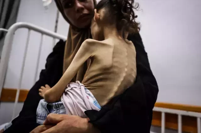 Yaşı 9, çəkisi 10 kq olan qəzzalı qızcığaz - FOTOLAR