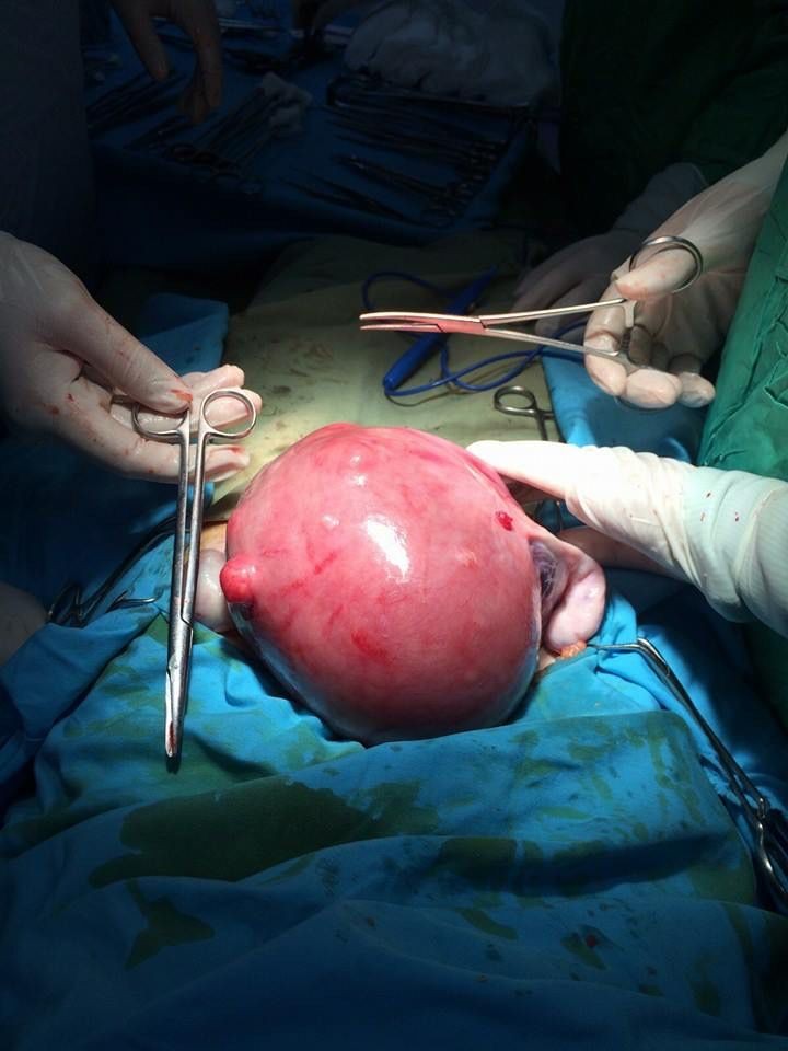 Uşaqlıq mioması təhlükəlidirmi? - Diaqnoz Tibb Mərkəzinin ginekoloqundan açıqlama