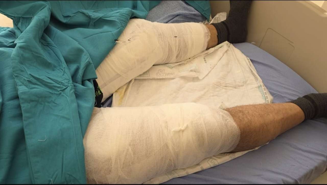 "Can şirindir, başladıq boğuşmağa" - Ayı hücumuna məruz qalan şəxs