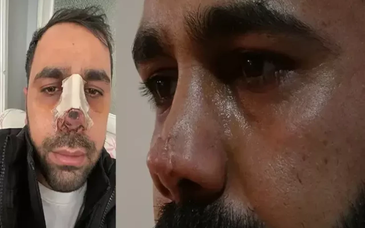 İkinci estetik əməliyyatdan sonra burnu çürüyür - FOTO