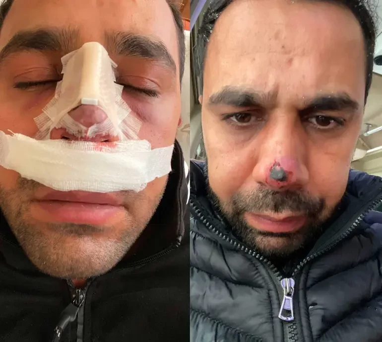 İkinci estetik əməliyyatdan sonra burnu çürüyür - FOTO