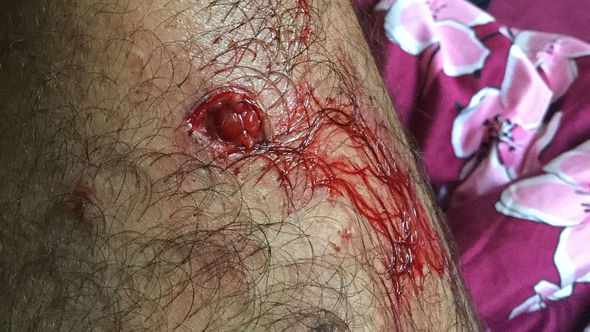 Zirəddin Rzayevi it dişlədi -   VİDEO-FOTO