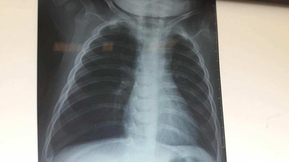 Bakıda 10 aylıq körpə tuma görə   əməliyyat olundu (FOTO)