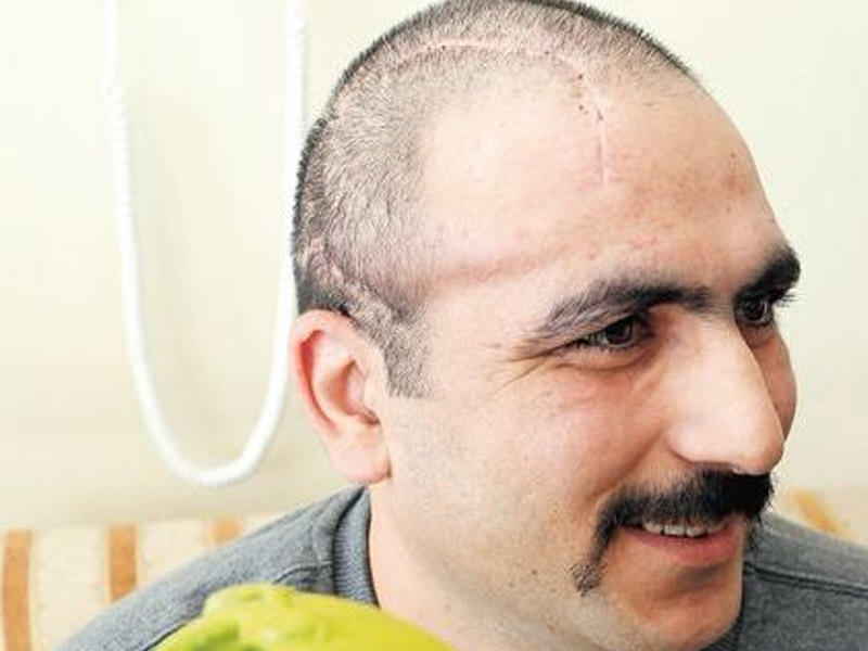 Aprel döyüşündə yaralanan hərbçiyə süni baş qapağı qoyuldu -    FOTO