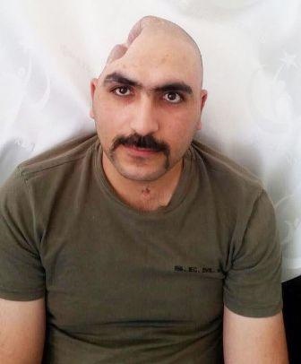 Aprel döyüşündə yaralanan hərbçiyə süni baş qapağı qoyuldu -    FOTO