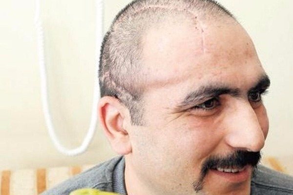 Aprel döyüşündə yaralanan hərbçiyə süni baş qapağı qoyuldu -    FOTO