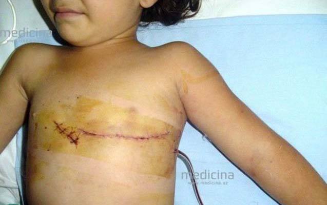 Bakıda 5 yaşlı qızın ürəyinə iynə batdı -  FOTO