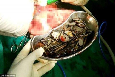 Depressiyaya düşən adamın mədəsindən çıxanlar şok yaratdı   - FOTO
