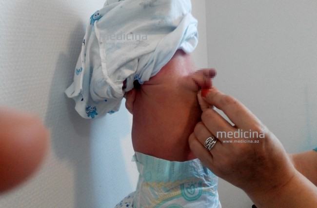Azərbaycanda kürəyində cinsi orqan olan körpə doğuldu -  FOTO