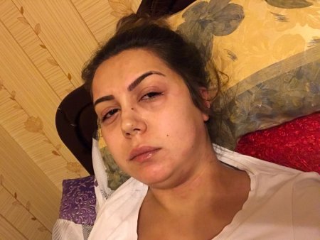 Xəstəlik azərbaycanlı müğənnini bu hala saldı -  FOTOLAR