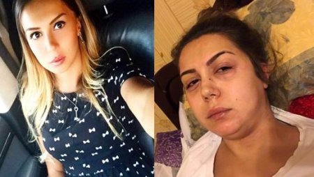 Xəstəlik azərbaycanlı müğənnini bu hala saldı -  FOTOLAR